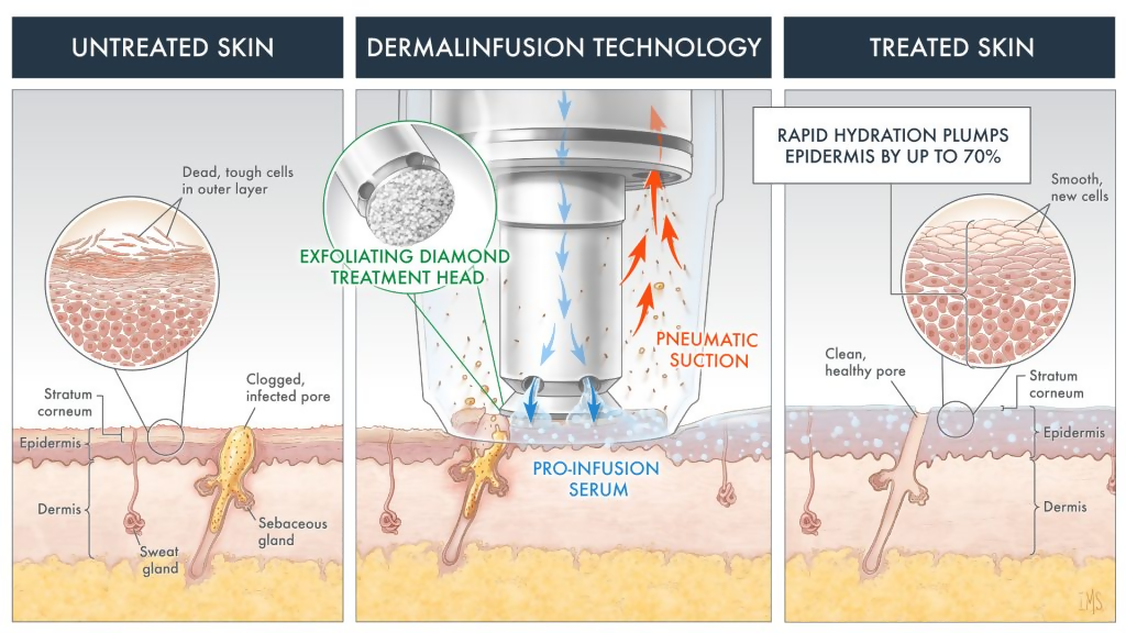 Dermal Infusion mech.of.action