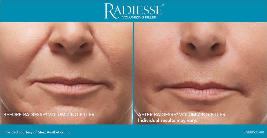 Radiesse B&A