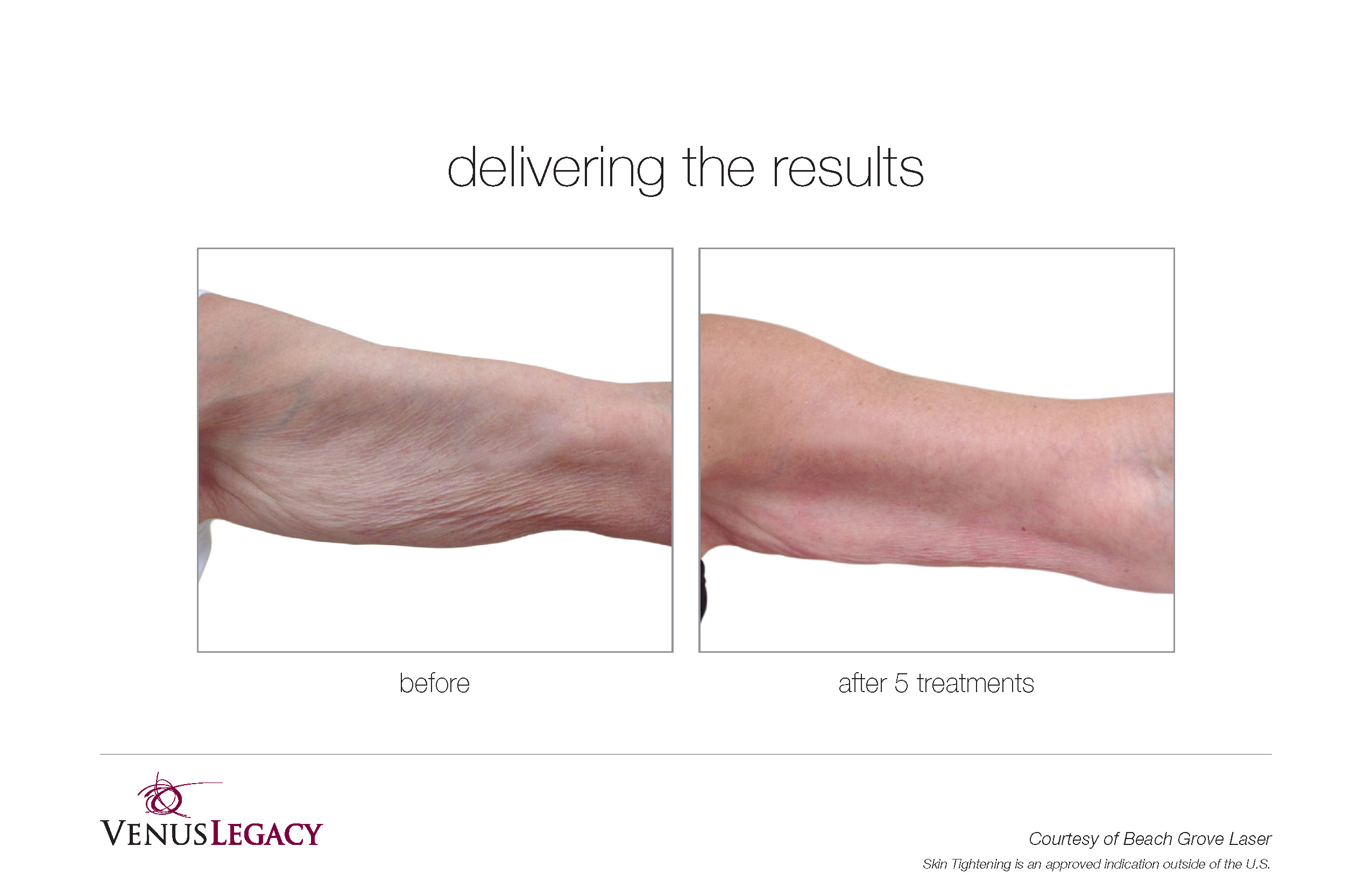 VenusLegacy_B&A ARM