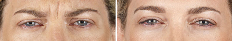 Xeomin before & After