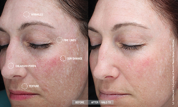 halo-before-after-Female