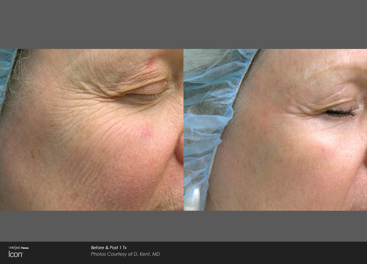 skin-resurfacing-b&a-formatted