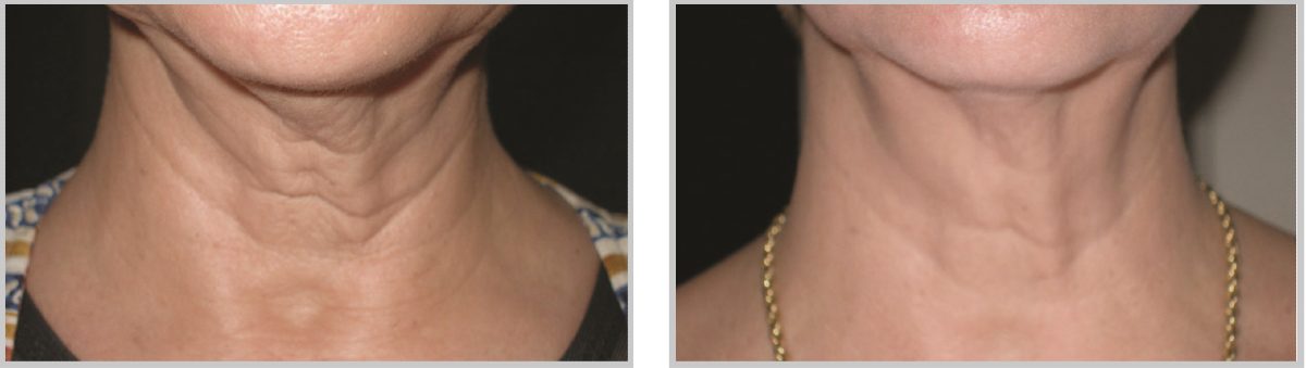skintyte-cropped