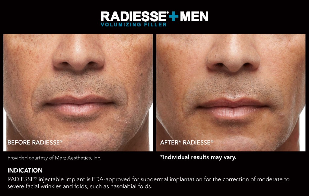 Radiesse Man